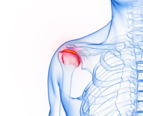 lesion hombro accidente trabajo
