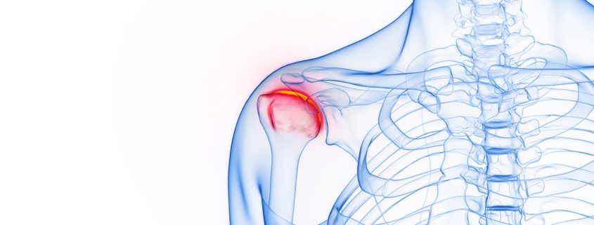 lesion hombro accidente trabajo